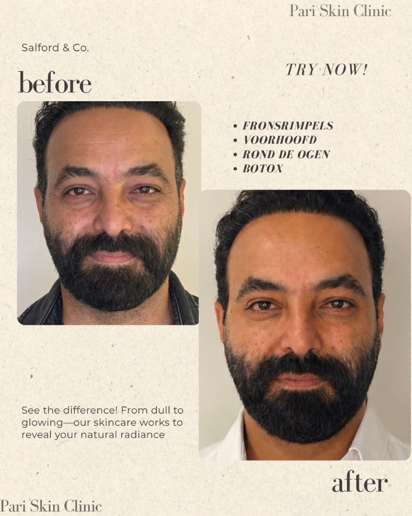 Voor en na Botox voorhoofd en oogzone bij Pari Skin Clinic