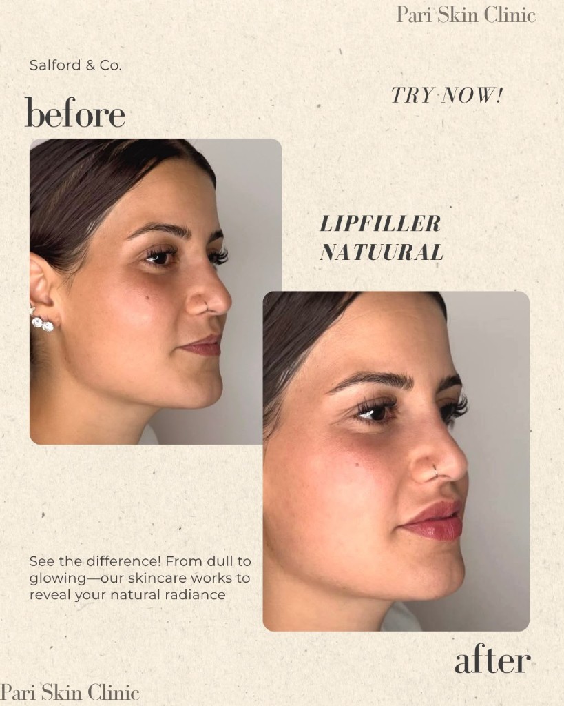 Voor en na lip filler met natuurlijk resultaat bij Pari Skin Clinic